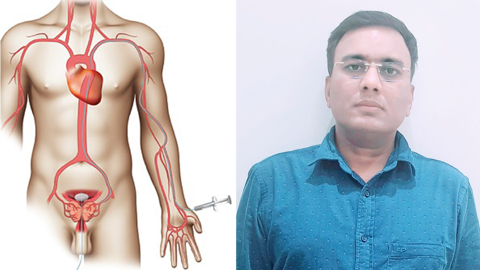 प्रोस्टेट संबंधी समस्याओं में सुरक्षित इलाज है प्रोस्टेटिक आर्टरी एम्बोलिजेशन-डॉ.शिवराज इंगोले