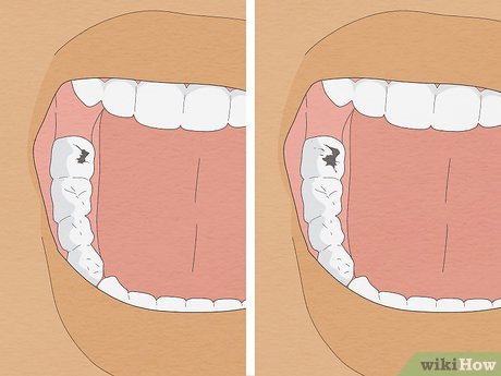 दांतों की कैविटी का घरेलू इलाज: पुराने नुस्खे जो आज भी कारगर हैं